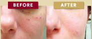 Laser acne treatment