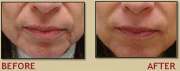 Juvaderm, Restylane and other fillers