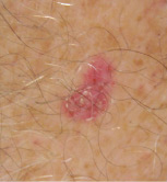 skin cancer diagnosis