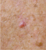 skin cancer screening