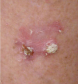 skin cancer care Wellesley