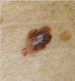 skin cancer screening in Newton area